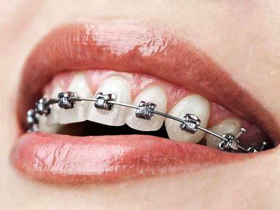 orthodontics-in-calicut
